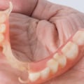 A Comprehensive Look at Flexible Partial Dentures