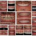 Success Stories and Testimonials: Real-Life Examples of Before-and-After Full Mouth Denture Cases