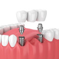 Benefits of Mini Dental Implants: A Comprehensive Look at the Advantages