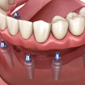 Combining Implants with Traditional Dentures for Better Stability and Aesthetics: What You Need to Know