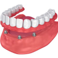 Understanding All-on-4 Dentures: What You Need to Know