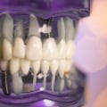 Common Issues with Dentures and How to Address Them
