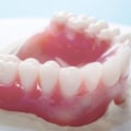 All You Need to Know About Traditional Full Dentures