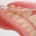 Factors Affecting the Cost of Dentures: What You Need to Know
