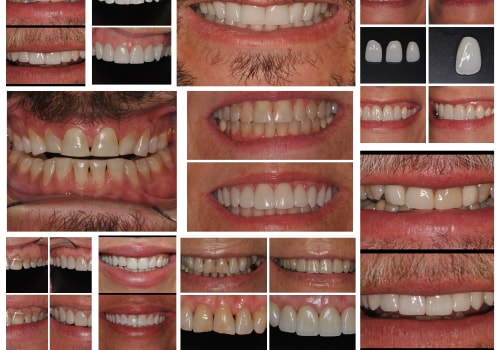 Success Stories and Testimonials: Real-Life Examples of Before-and-After Full Mouth Denture Cases