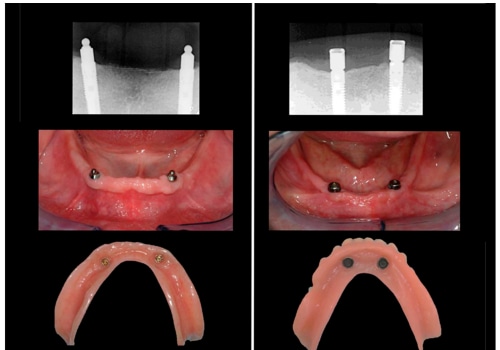 Understanding Implant-Supported Overdentures: A Comprehensive Guide