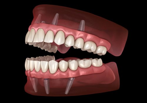 Cost Comparison: Alternative Options to Traditional Dentures