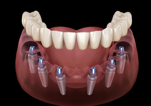 A Comprehensive Guide to All-on-6 Dentures