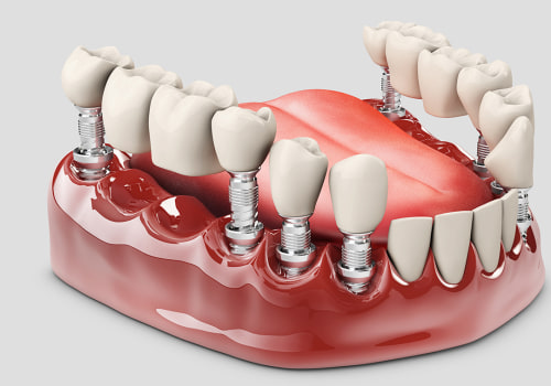 Understanding Fixed Partial Dentures for Better Dental Health