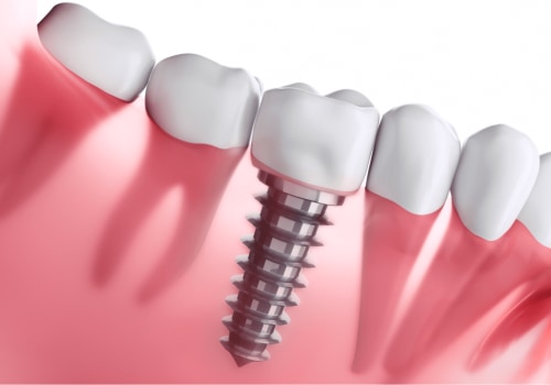 The Many Types of Dental Implants Available for a Confident Smile